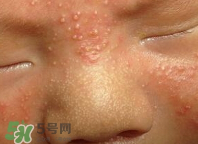 新生兒痤瘡怎么治療-癥狀 新生兒痤瘡怎么治療-癥狀