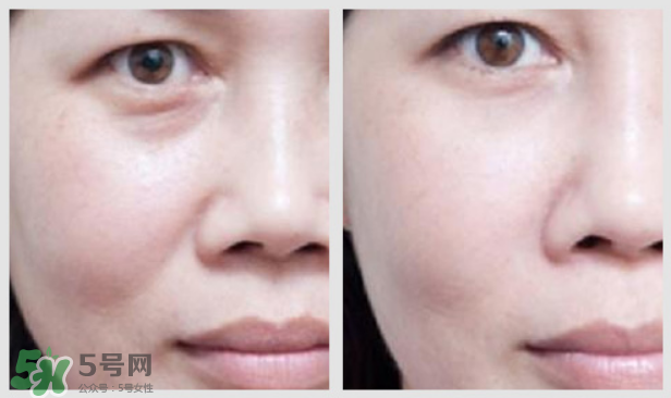 法令紋怎么消除？如何正確對(duì)待法令紋？