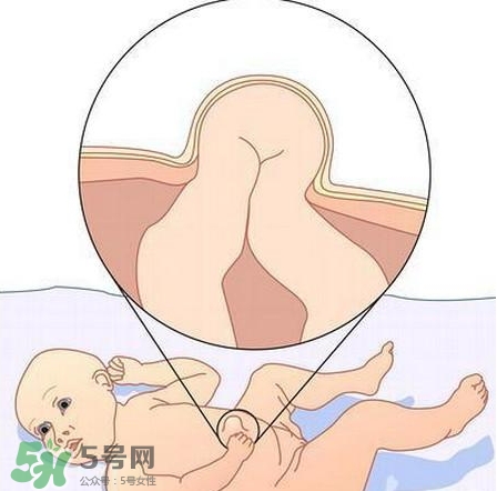 臍疝是什么？臍疝對寶寶有什么影響？