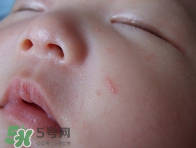 新生兒痤瘡怎么治療-癥狀 新生兒痤瘡怎么治療-癥狀