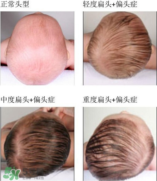 寶寶頭型是睡出來的嗎？寶寶頭型矯正最佳時(shí)間