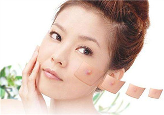 痘痘肌的護(hù)膚品怎么挑？正確挑選祛痘產(chǎn)品