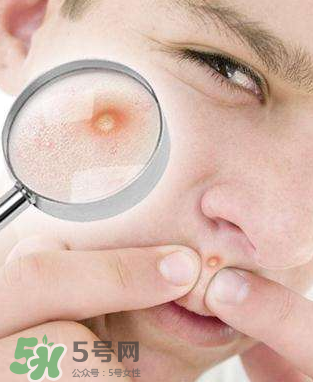 痘痘是如何形成的？食物祛痘法