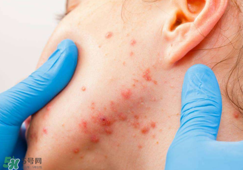 痤瘡的分類 痤瘡的護理原則 痤瘡的分類 痤瘡的護理原則