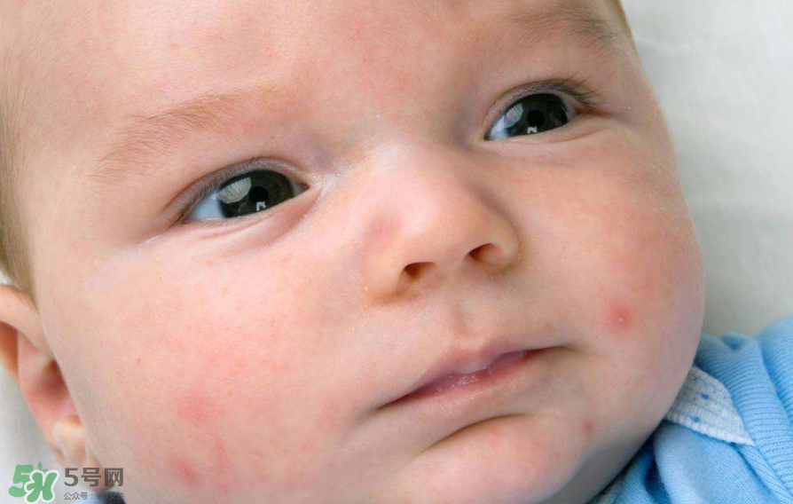 痤瘡的分類 痤瘡的護理原則 痤瘡的分類 痤瘡的護理原則