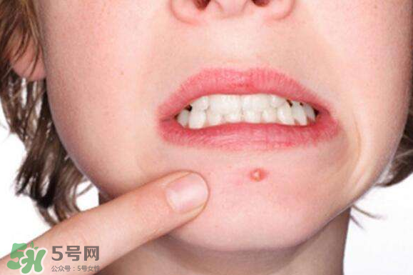 暗瘡可以擠壓嗎？油性和骯臟肌膚會容易有暗瘡嗎？