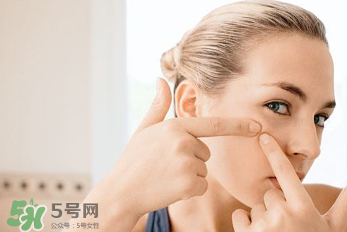 暗瘡可以擠壓嗎？油性和骯臟肌膚會容易有暗瘡嗎？