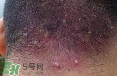 痤瘡和毛囊炎一樣嗎？痤瘡與毛囊炎區(qū)別