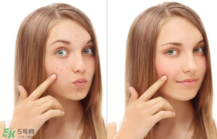 痤瘡和毛囊炎一樣嗎？痤瘡與毛囊炎區(qū)別