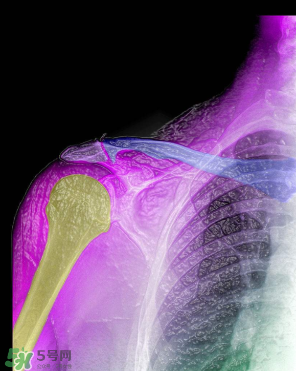 骨刺是怎么形成的？骨刺怎么治療？