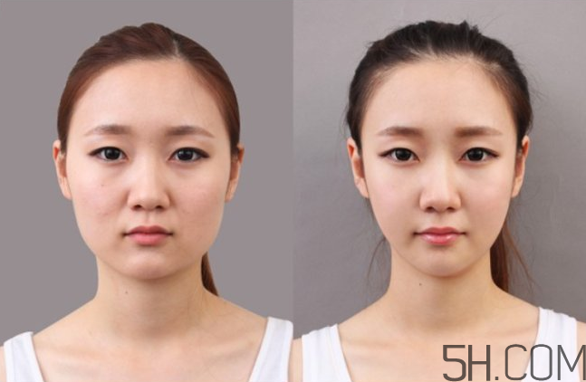 瘦臉針有依賴(lài)嗎？打瘦臉針有依賴(lài)性嗎？