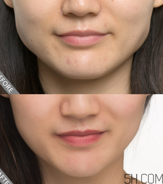 瘦臉針需要打幾次有效？瘦臉針需要打幾次定型？