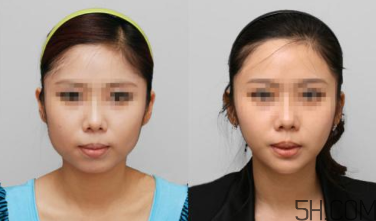 瘦臉針要做皮試嗎？瘦臉針皮試怎么做？