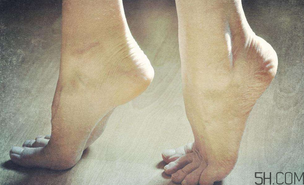 腳氣是什么原因引起的？腳氣是濕氣重引起的嗎?