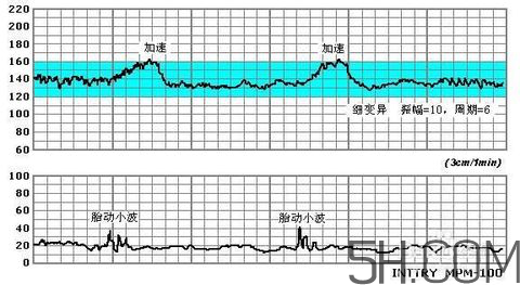 為什么要做胎心監(jiān)護？孕婦做胎心監(jiān)護有什么用？