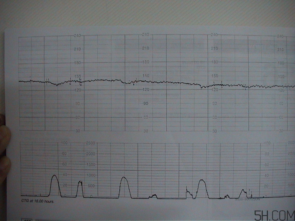 為什么要做胎心監(jiān)護？孕婦做胎心監(jiān)護有什么用？