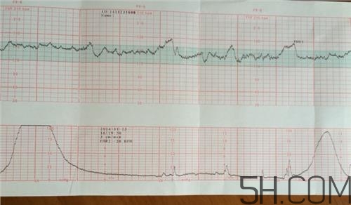 為什么要做胎心監(jiān)護？孕婦做胎心監(jiān)護有什么用？