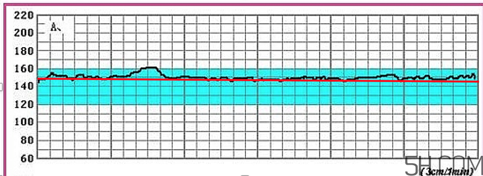 為什么要做胎心監(jiān)護？孕婦做胎心監(jiān)護有什么用？