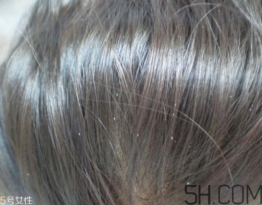 頭虱和頭皮屑怎么區(qū)分？頭虱是怎樣生成的