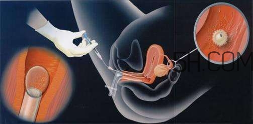 人工授精取卵子怎么?。咳斯な诰腥嗽鯓尤【?？