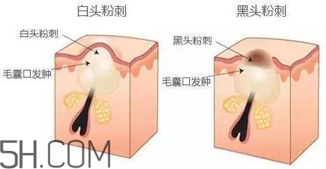 去黑頭的最好方法 5分鐘快速祛黑頭 去黑頭的最好方法 5分鐘快速祛黑頭