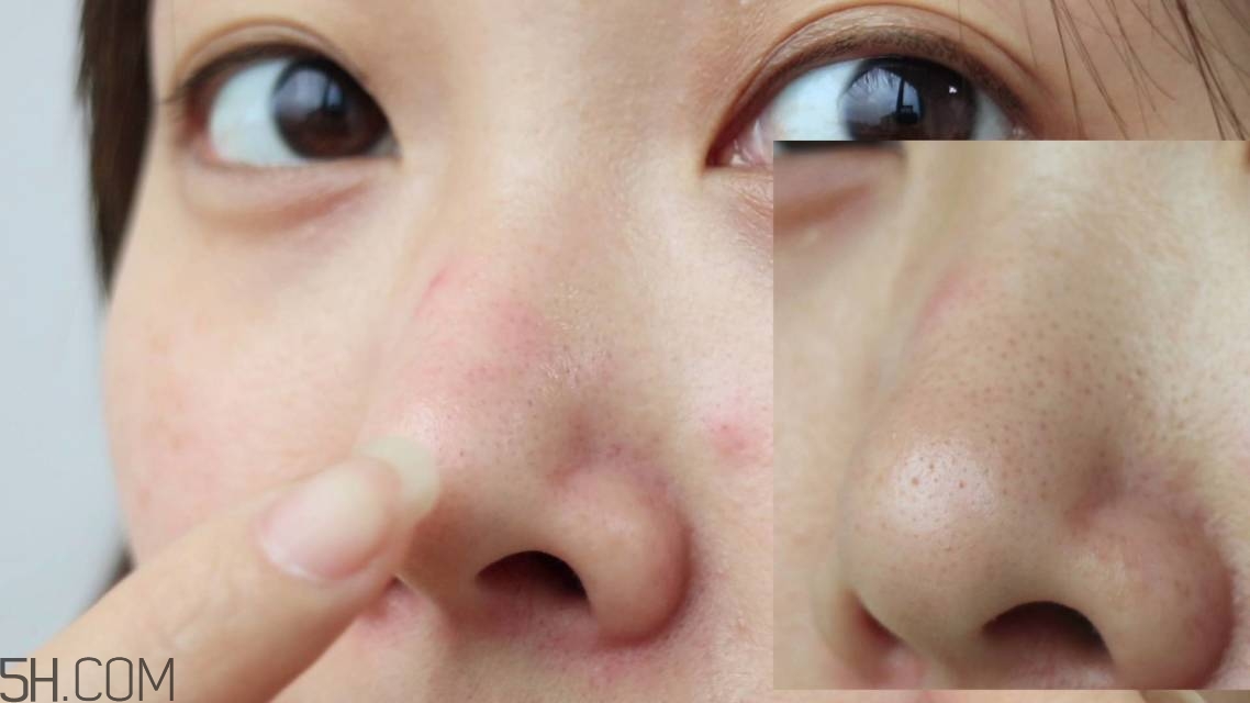 去黑頭的最好方法 5分鐘快速祛黑頭 去黑頭的最好方法 5分鐘快速祛黑頭