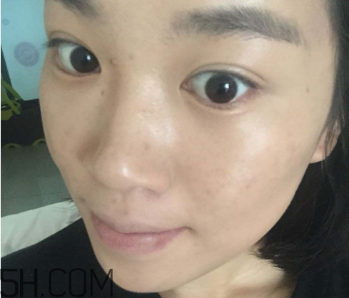 上宮莊祛痘騙局 上宮莊祛痘怎么樣 上宮莊祛痘騙局 上宮莊祛痘怎么樣