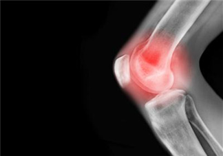 關(guān)節(jié)炎需要補(bǔ)鈣嗎？關(guān)節(jié)炎補(bǔ)鈣有用嗎？