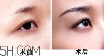 切眉手術(shù)后老得快嗎？切眉能保持多久？