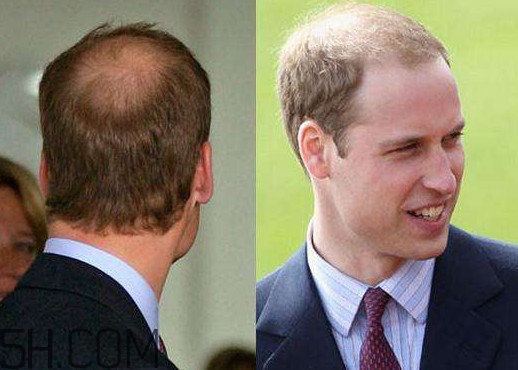 什么樣的人容易禿頂？為什么女人不禿頂