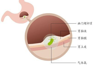 幽門螺桿菌的癥狀有哪些表現(xiàn)？幽門螺旋菌怎么治療