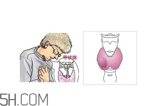 為什么會得甲狀腺結(jié)節(jié)？甲狀腺節(jié)結(jié)是什么？