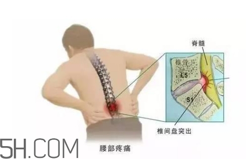 腰間盤突出是什么原因引起的？腰間盤突出是腎虛嗎