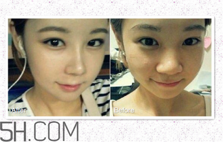 鼻頭縮小術(shù)過程圖 鼻頭縮小手術(shù)千萬別做后悔死 鼻頭縮小術(shù)過程圖 鼻頭縮小手術(shù)千萬別做后悔死