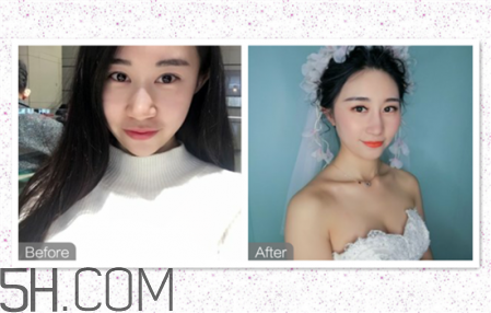 鼻頭縮小術(shù)過程圖 鼻頭縮小手術(shù)千萬別做后悔死 鼻頭縮小術(shù)過程圖 鼻頭縮小手術(shù)千萬別做后悔死