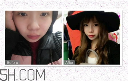 鼻頭縮小術(shù)過程圖 鼻頭縮小手術(shù)千萬別做后悔死 鼻頭縮小術(shù)過程圖 鼻頭縮小手術(shù)千萬別做后悔死