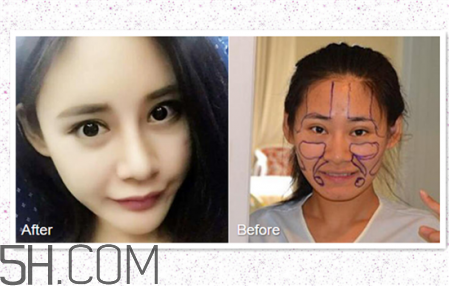 鼻頭縮小術(shù)過程圖 鼻頭縮小手術(shù)千萬別做后悔死 鼻頭縮小術(shù)過程圖 鼻頭縮小手術(shù)千萬別做后悔死