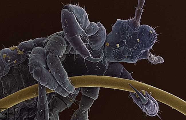 孩子長虱子是怎么回事？孩子長虱子該怎么辦？