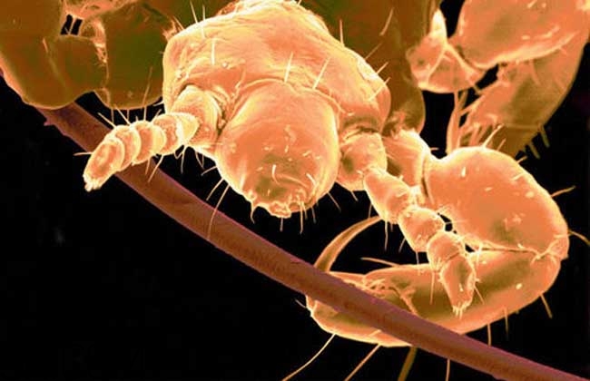 孩子長虱子是怎么回事？孩子長虱子該怎么辦？