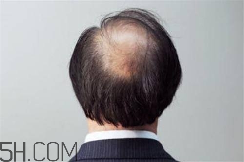 為什么男性比女性更容易脫發(fā)？什么原因?qū)е履行悦摪l(fā)？