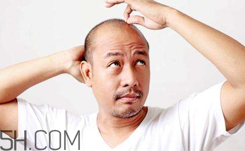 為什么男性比女性更容易脫發(fā)？什么原因?qū)е履行悦摪l(fā)？