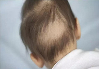 寶寶枕禿怎么辦？如何改善寶寶枕禿現(xiàn)象？