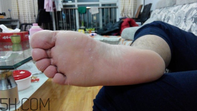 腳氣可以用酒精消毒嗎？腳氣可以用碘伏消毒嗎？