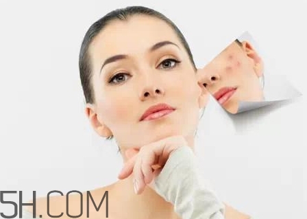 刷酸爆痘期有多長？刷酸要爆幾周的痘？