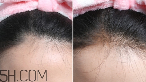 發(fā)際線不好看怎么修飾 完美解決6種發(fā)際線問題 發(fā)際線不好看怎么修飾 完美解決6種發(fā)際線問題