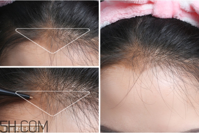 發(fā)際線不好看怎么修飾 完美解決6種發(fā)際線問題 發(fā)際線不好看怎么修飾 完美解決6種發(fā)際線問題