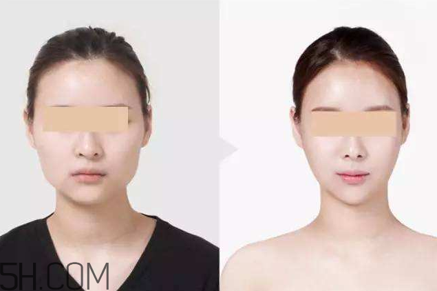 打瘦臉針可以抽煙嗎？打瘦臉針會反彈嗎？