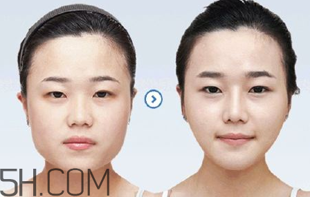 打瘦臉針可以抽煙嗎？打瘦臉針會反彈嗎？