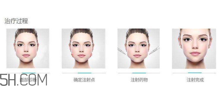 打瘦臉針可以抽煙嗎？打瘦臉針會反彈嗎？