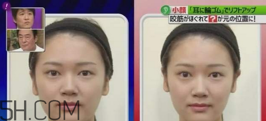 打瘦臉針的前后注意事項 臉胖的原因有哪些 打瘦臉針的前后注意事項 臉胖的原因有哪些